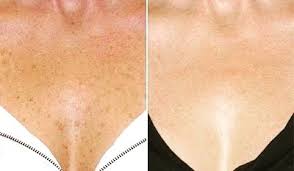 ¿Es seguro el tratamiento Ultraformer HIFU en Guadalajara?