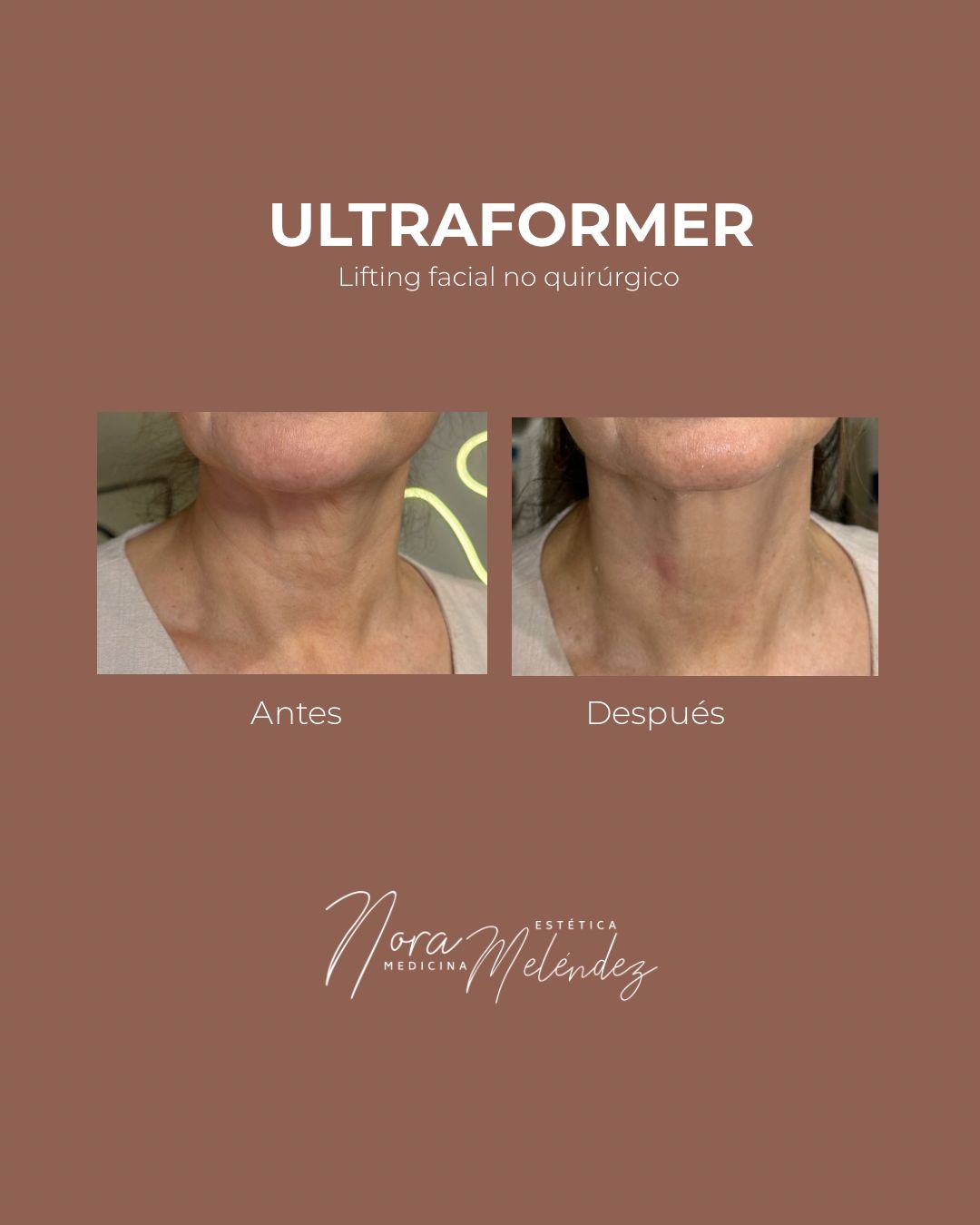 como corregir cuello flojo o flacido aguado arrugado